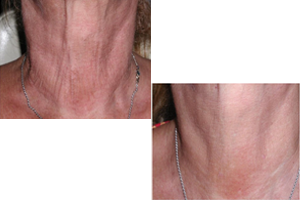 Karisma – Stimulation of Collagen Production – Anti – Aging